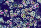 Measles Outbreak Spreads From SC to Washington State