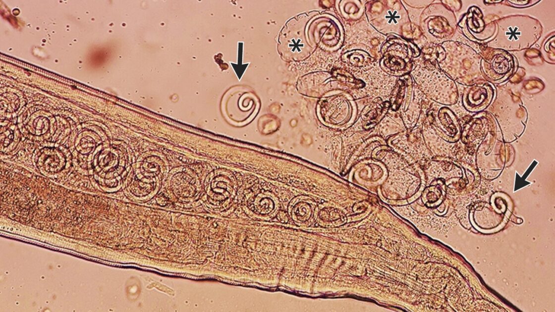 Man Has 11 Living Worms Pulled From His Eyes in South Korea
